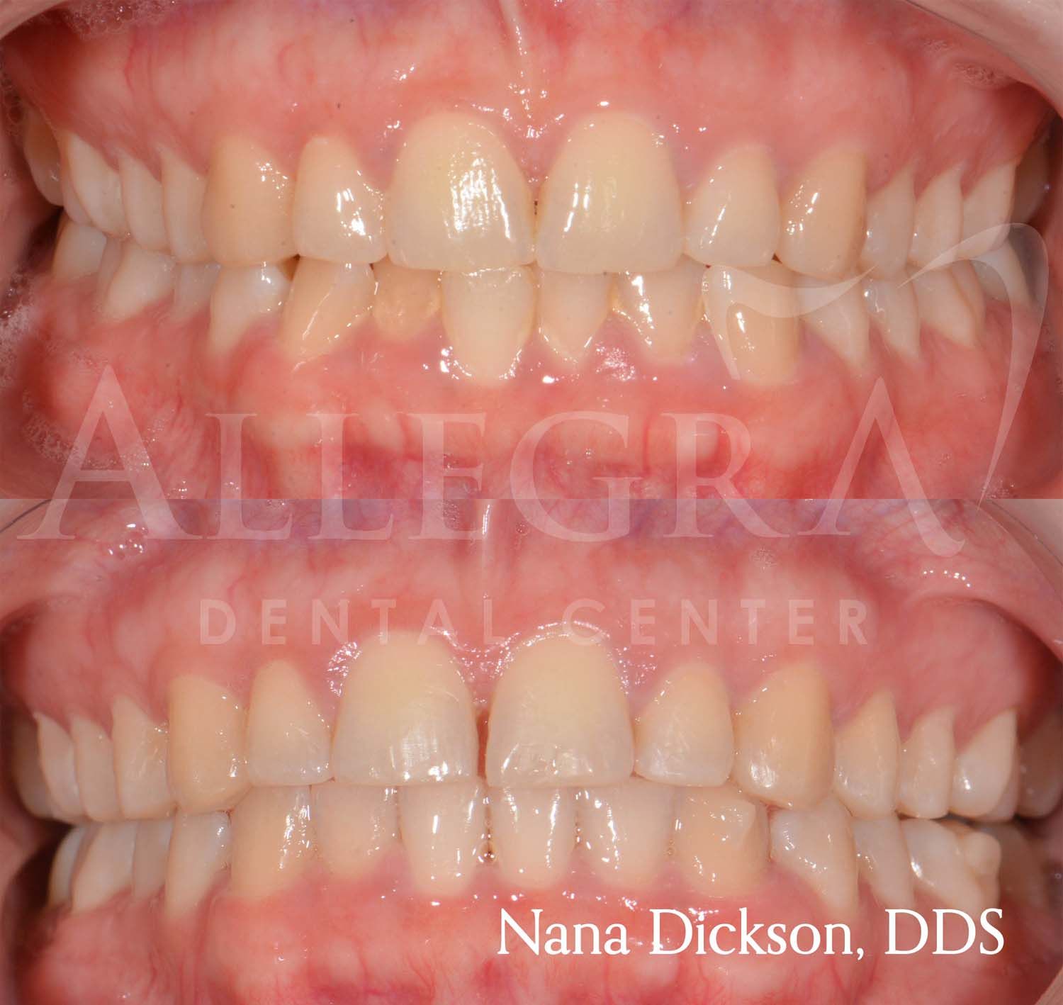 Invisalign before and after example from Allegra Dental Center