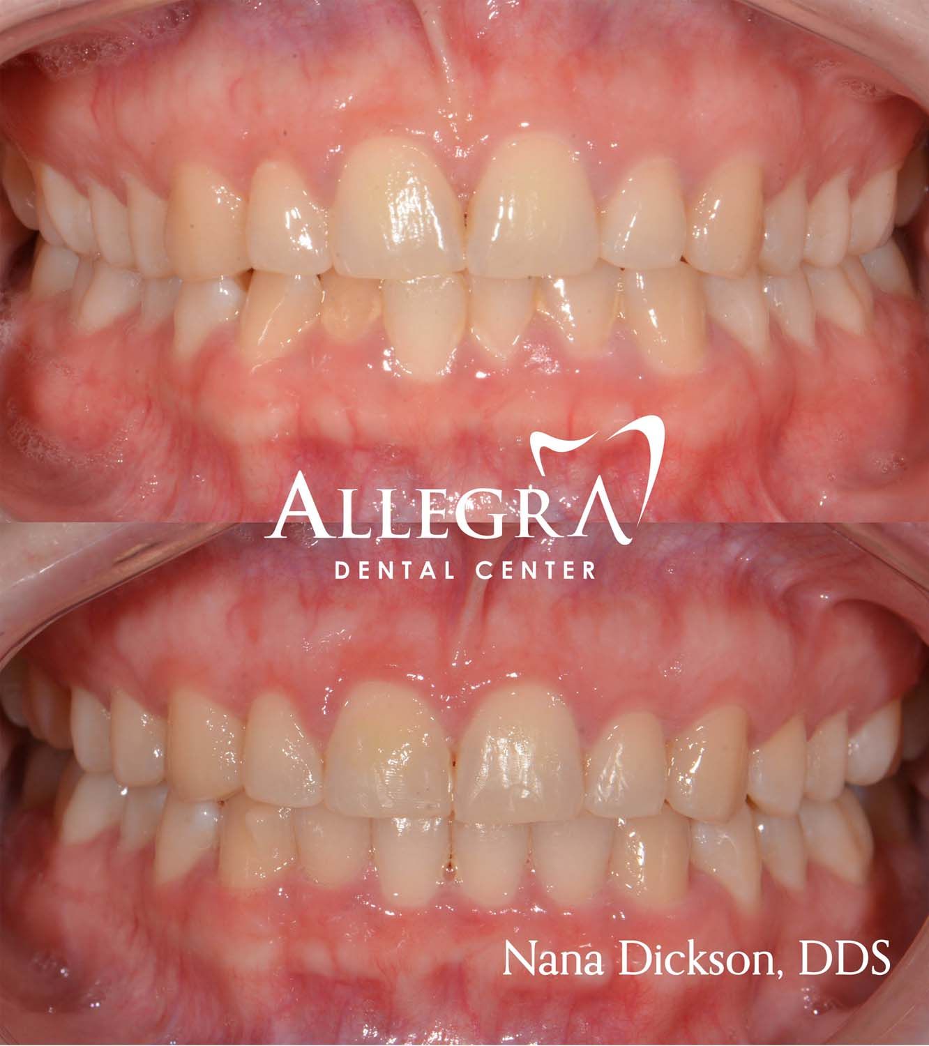 Invisalign Before and After case 2 from Allegra Dental Center