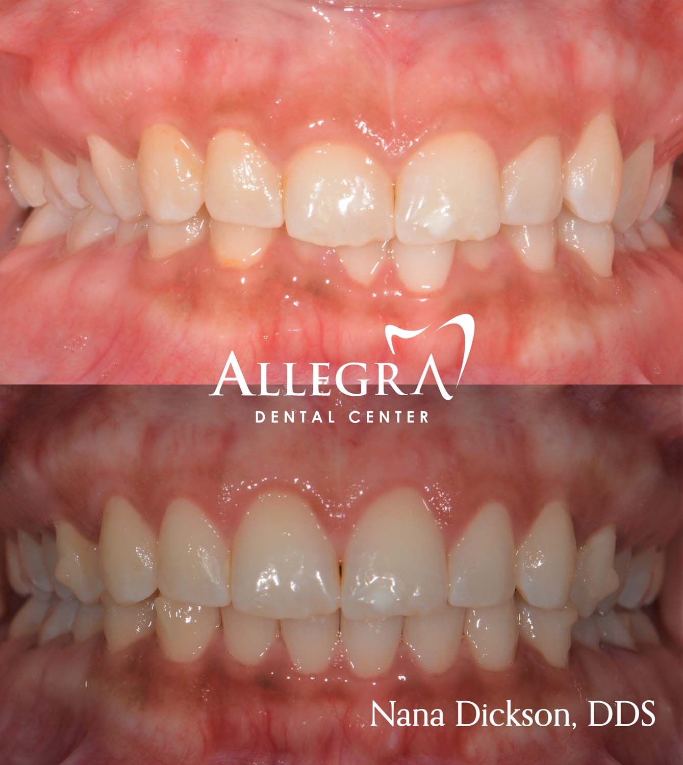 Invisalign Before and After case 3 from Allegra Dental Center