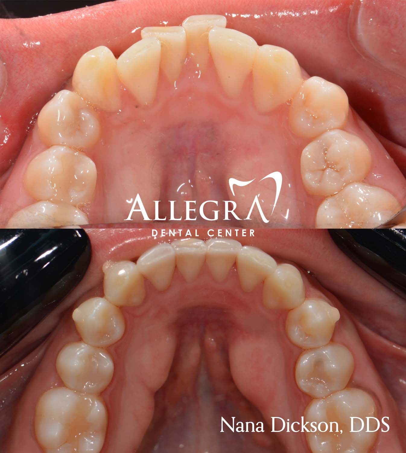 Invisalign Before and After case 4 from Allegra Dental Center