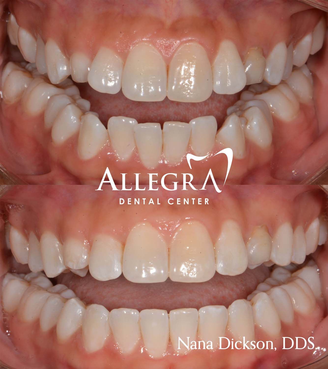 Invisalign Before and After case 6 from Allegra Dental Center