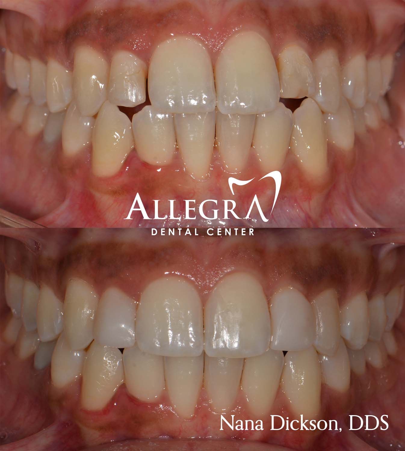 Invisalign Before and After case 7 from Allegra Dental Center