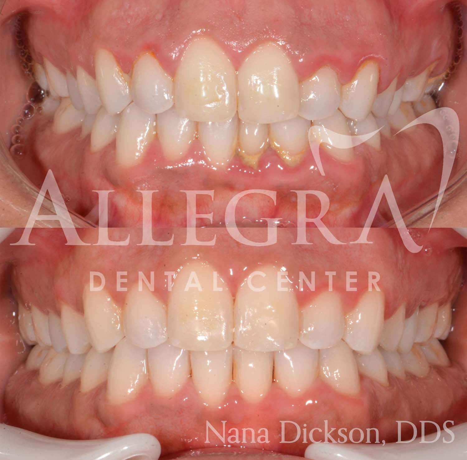Invisalign Before and After case 11 from Allegra Dental Center