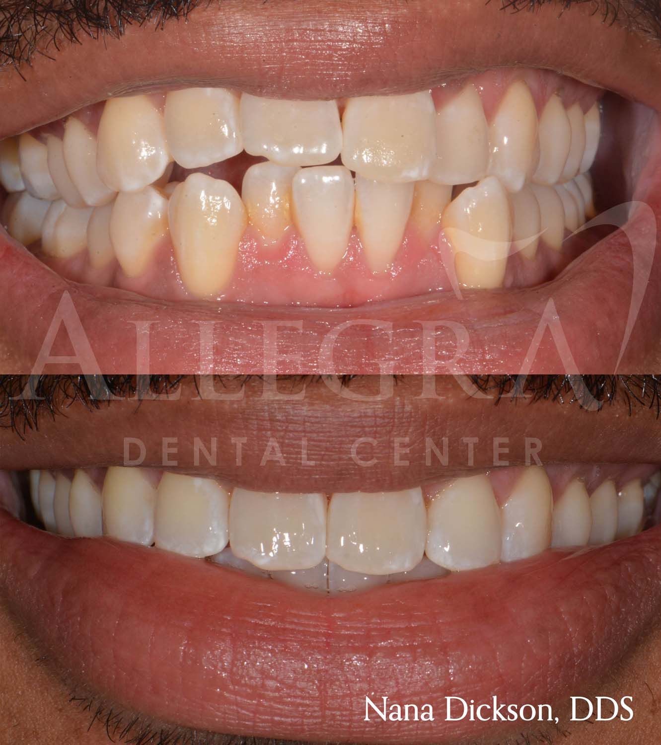 Invisalign Before and After case 15 from Allegra Dental Center
