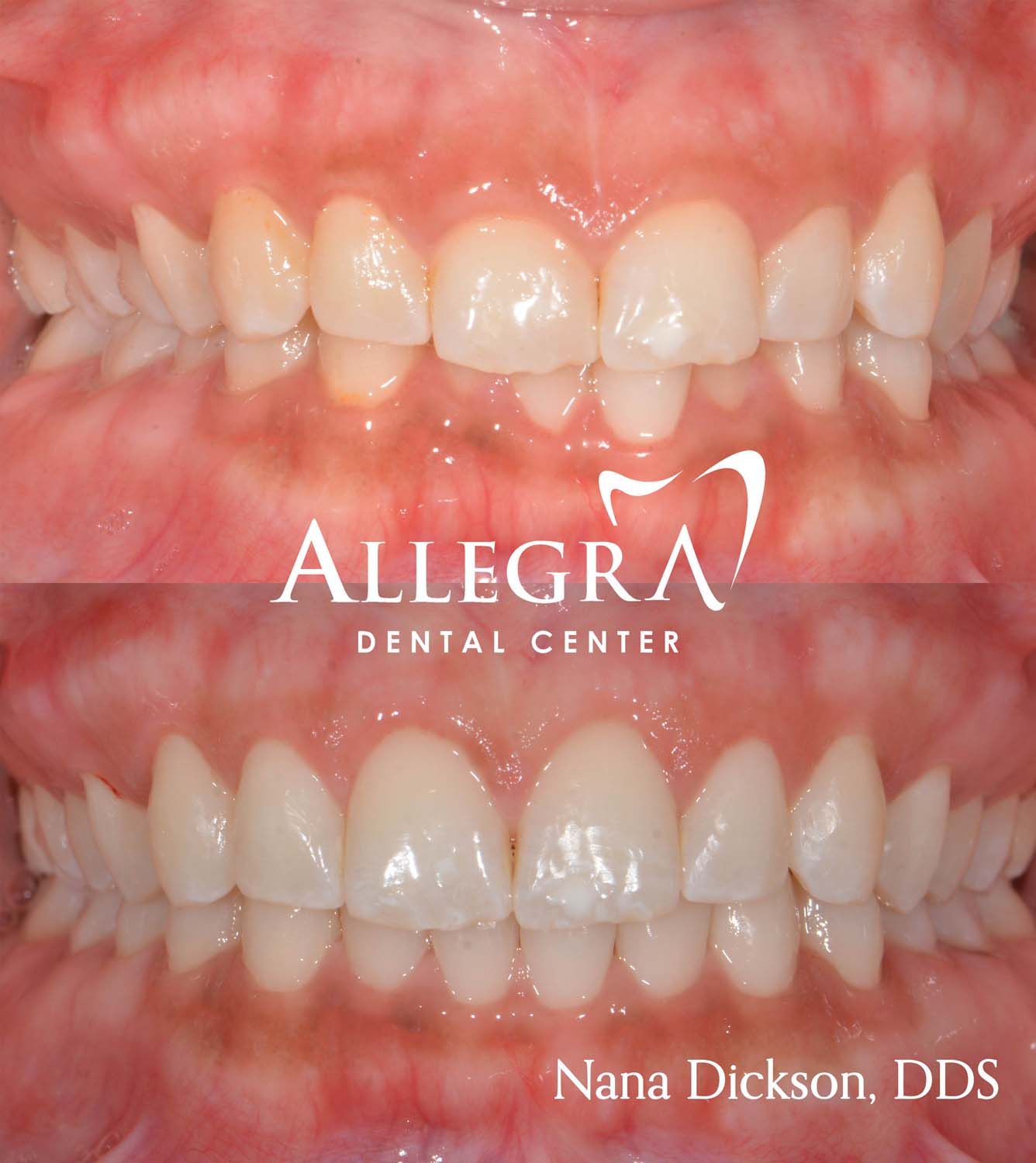 Invisalign Before and After case 16 from Allegra Dental Center