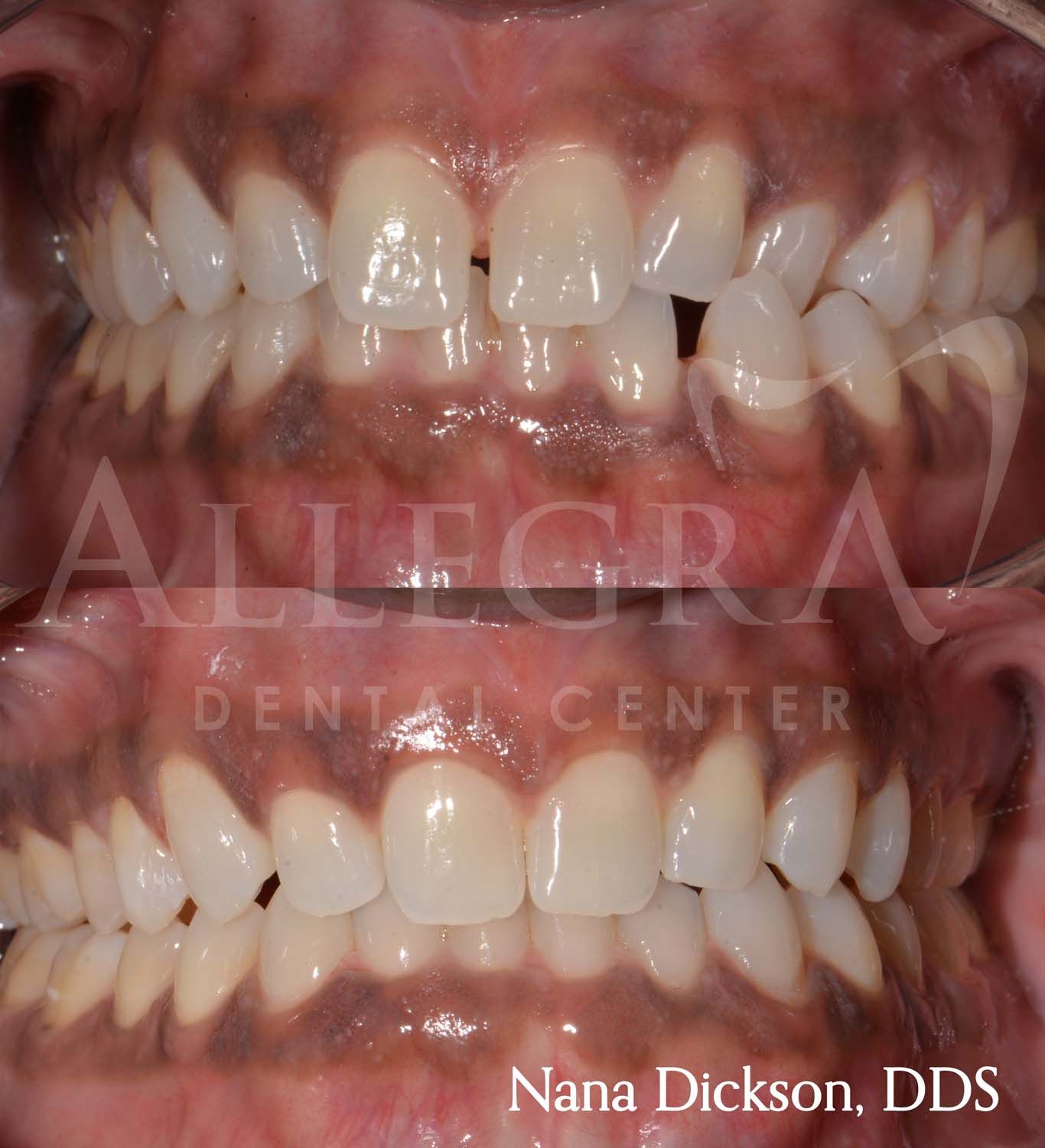 Invisalign Before and After case 17 from Allegra Dental Center