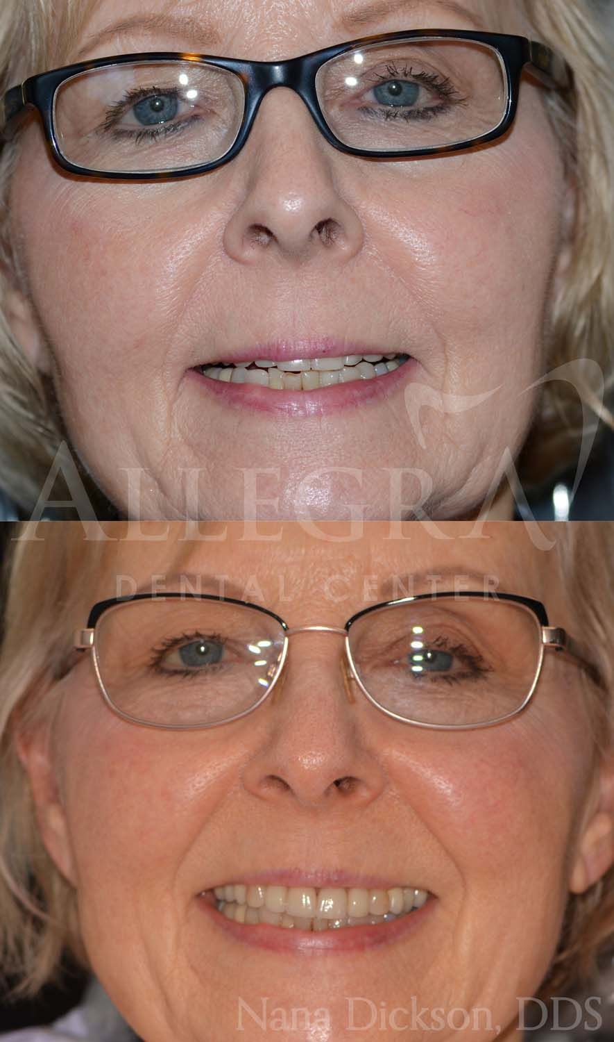 Invisalign Before and After case 18 from Allegra Dental Center