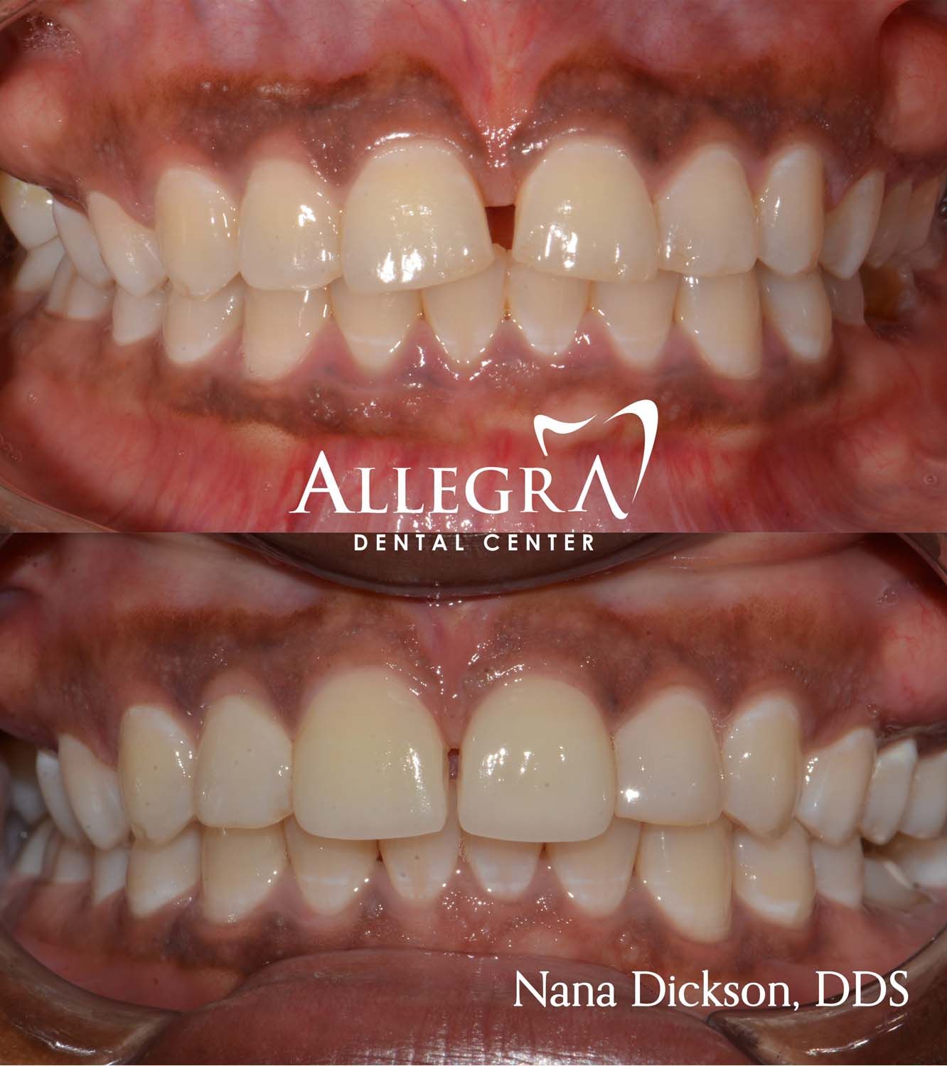 Invisalign Before and After case 20 from Allegra Dental Center