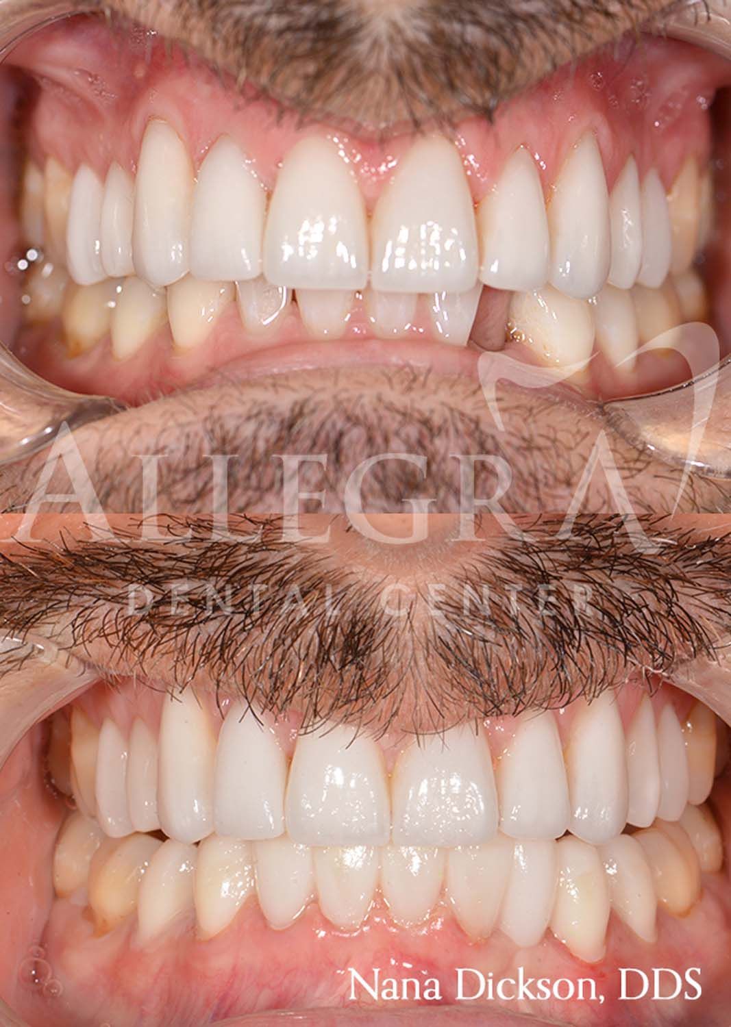 Invisalign Before and After case 22 from Allegra Dental Center