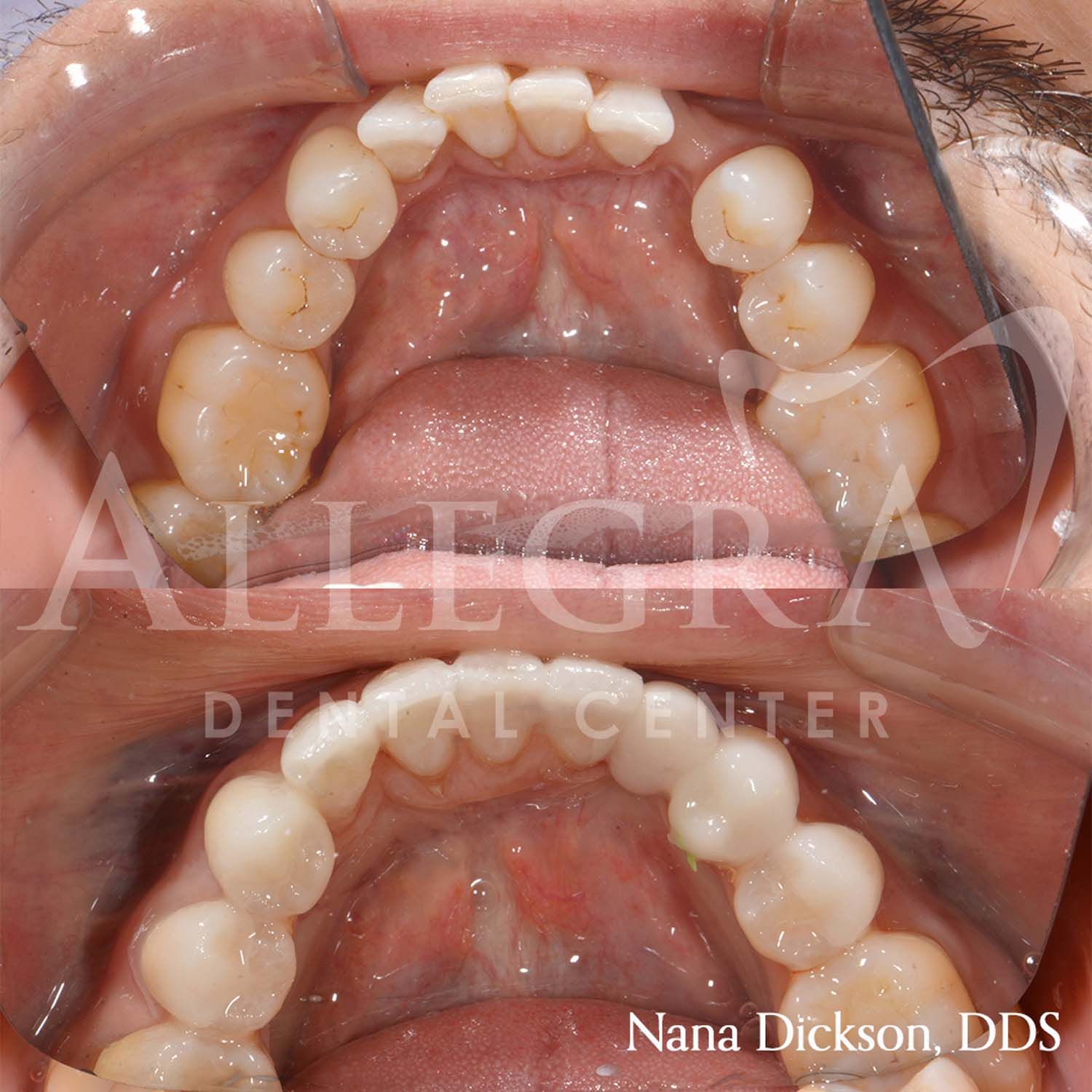 Invisalign Before and After case 23 from Allegra Dental Center