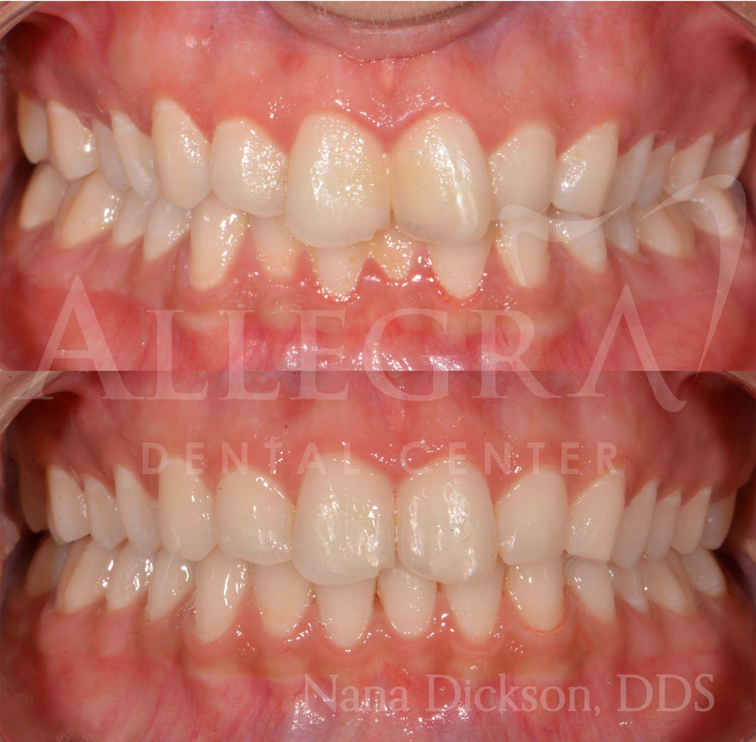 Invisalign Before and After case 26 from Allegra Dental Center