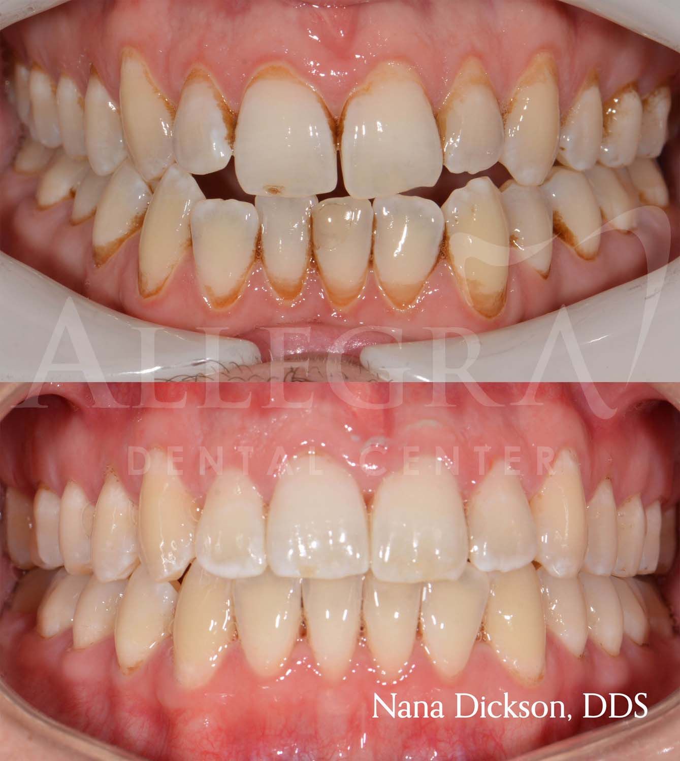 Invisalign Before and After case 27 from Allegra Dental Center