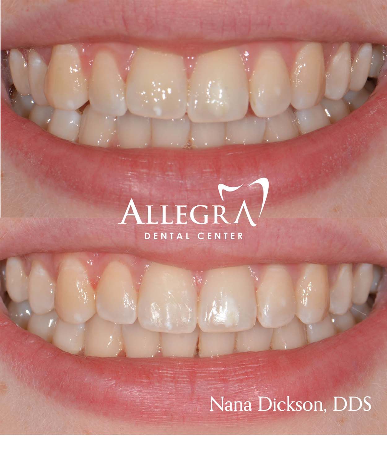 Invisalign Before and After case 30 from Allegra Dental Center