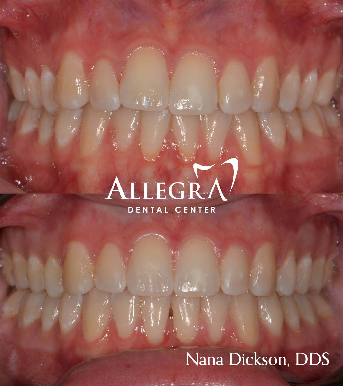 Invisalign Before and After case 31 from Allegra Dental Center