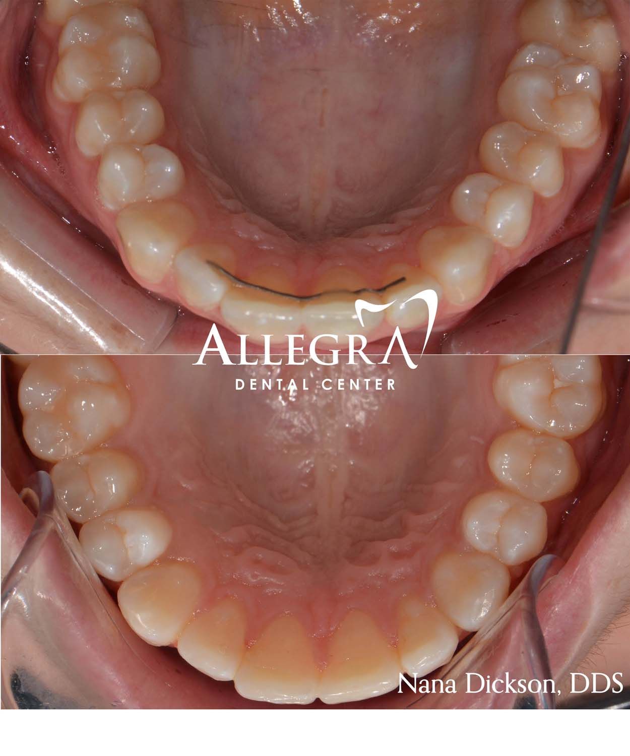 Invisalign Before and After case 32 from Allegra Dental Center