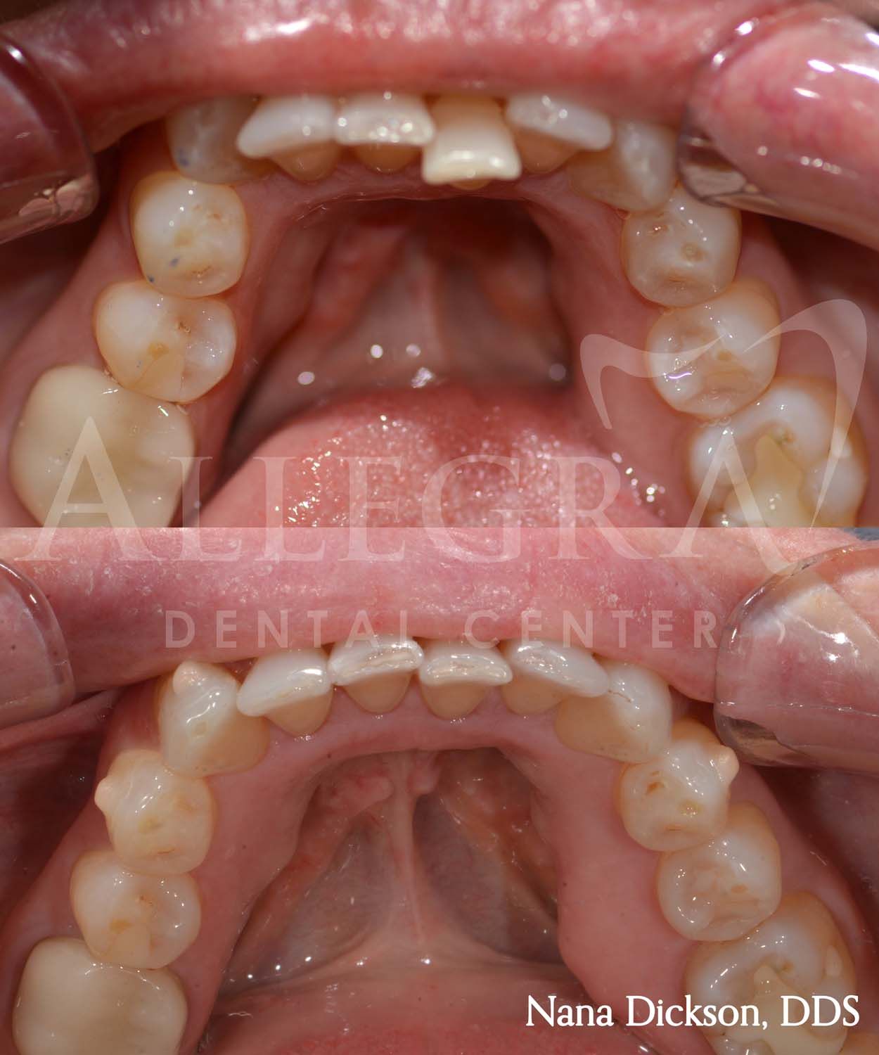 Invisalign Before and After case 35 from Allegra Dental Center