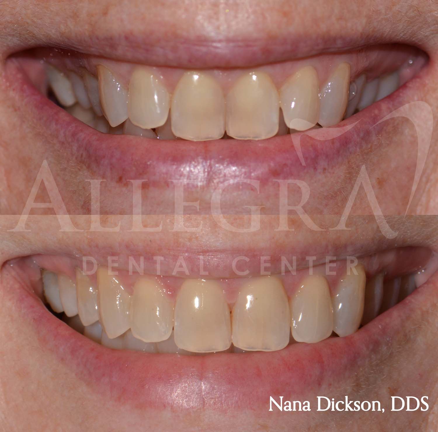 Invisalign Before and After case 37 from Allegra Dental Center