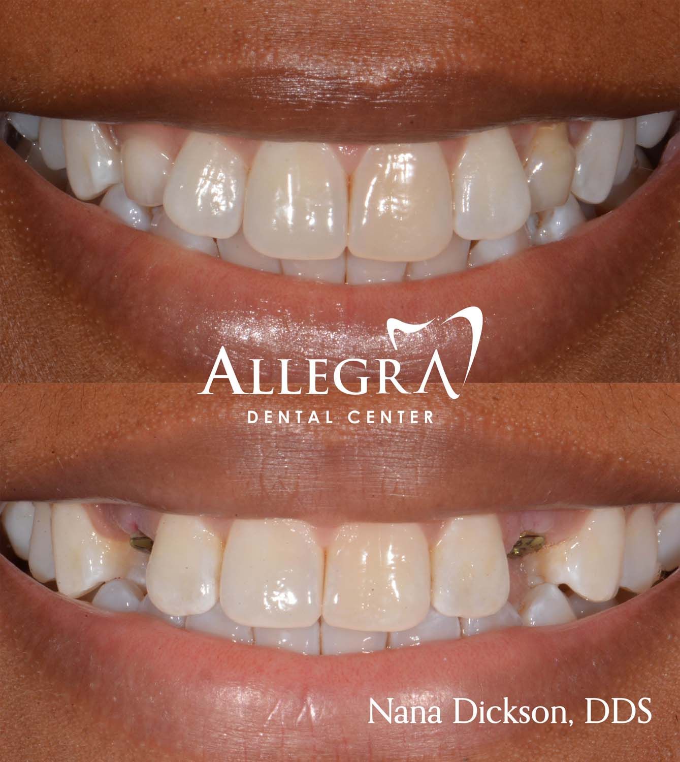Invisalign Before and After case 39 from Allegra Dental Center