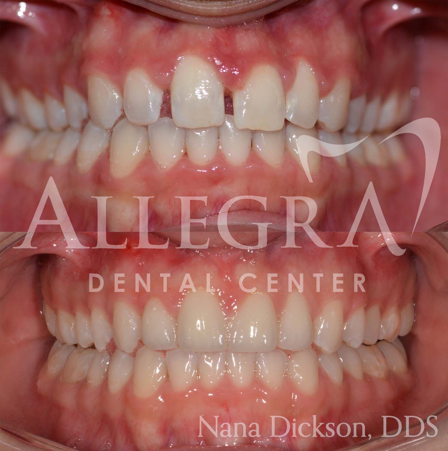 Invisalign Before and After case 42 from Allegra Dental Center