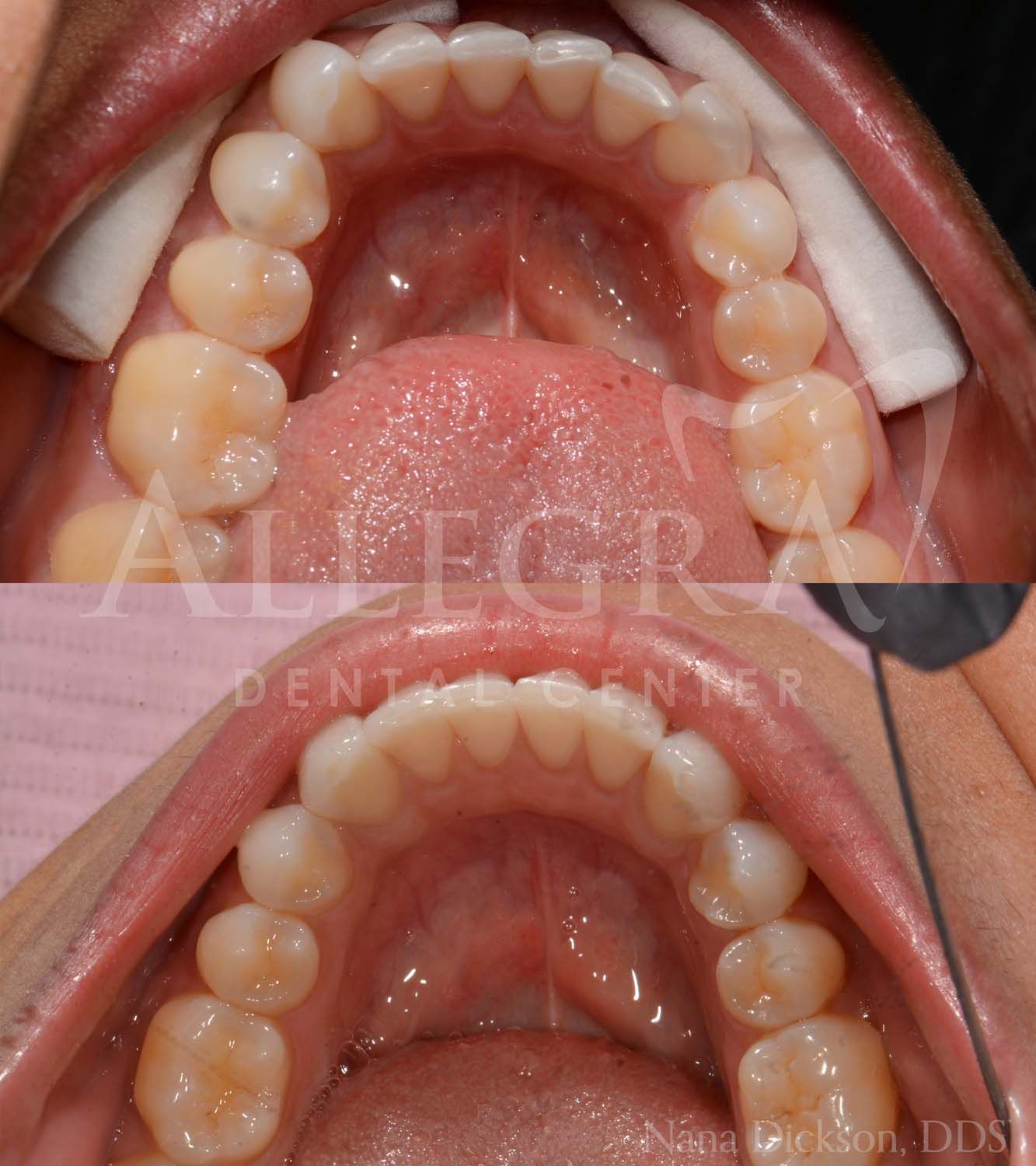 Invisalign Before and After case 43 from Allegra Dental Center