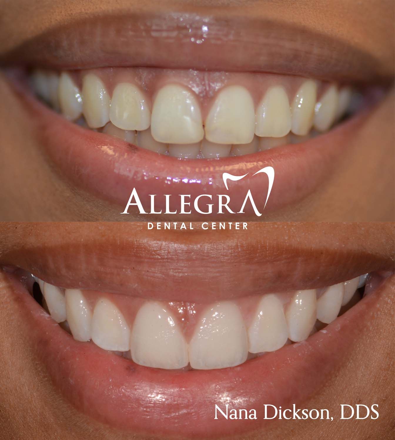 Veneers before and after example from Allegra Dental Center