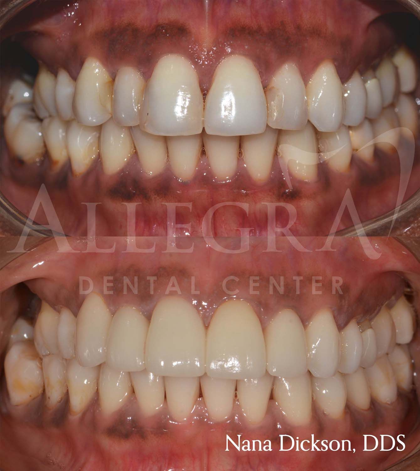 Veneers Before and After case 4 from Allegra Dental Center