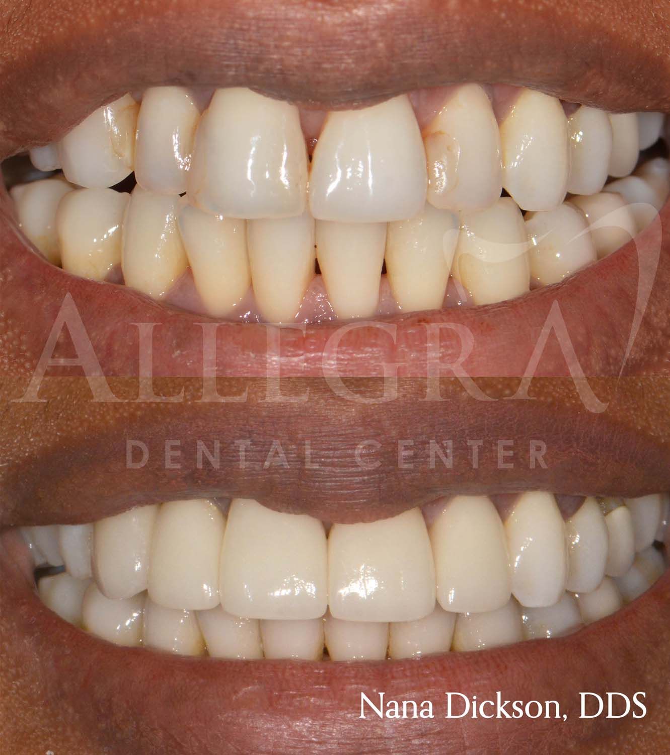 Veneers Before and After case 5 from Allegra Dental Center