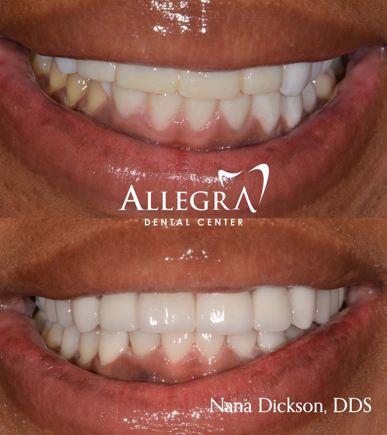 Veneers Before and After case 6 from Allegra Dental Center
