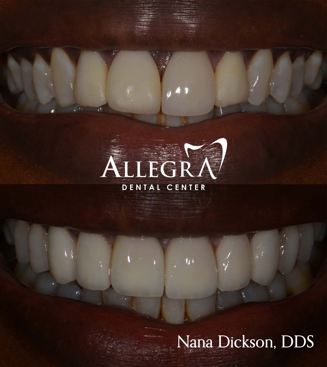 Veneers Before and After case 7 from Allegra Dental Center