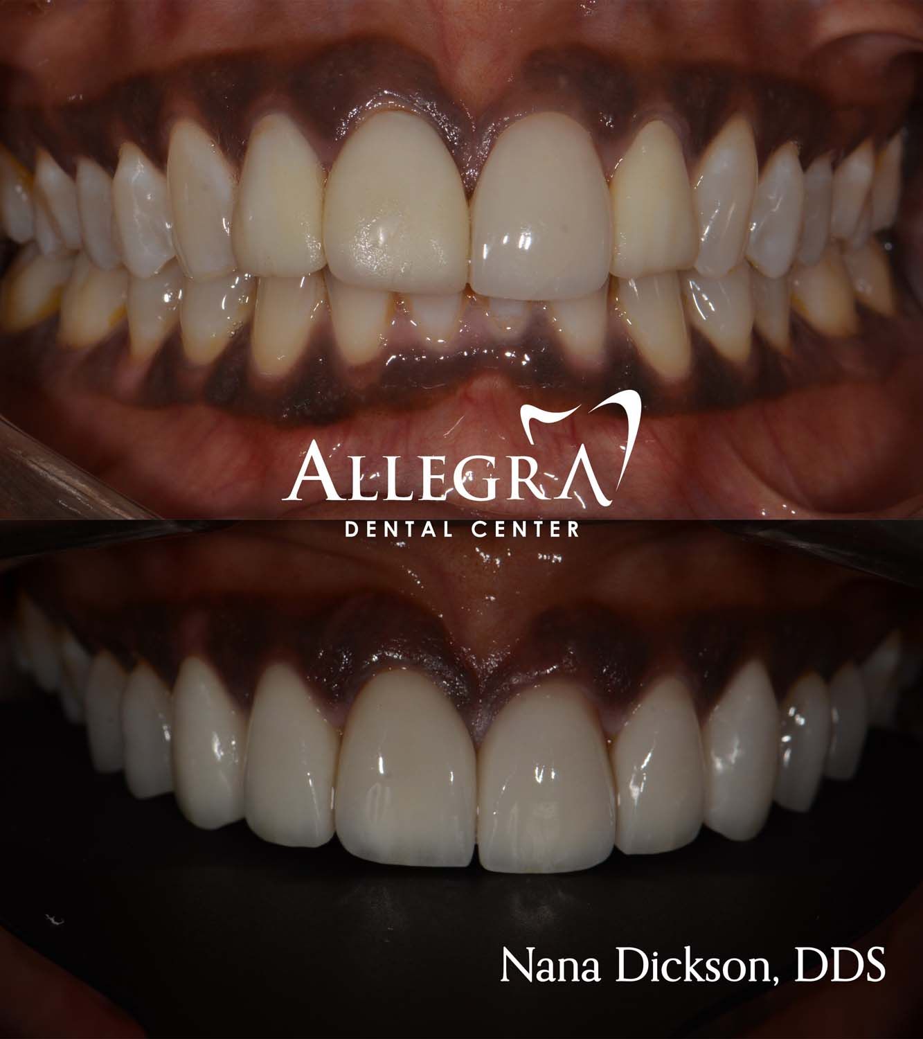 Veneers Before and After case 8 from Allegra Dental Center