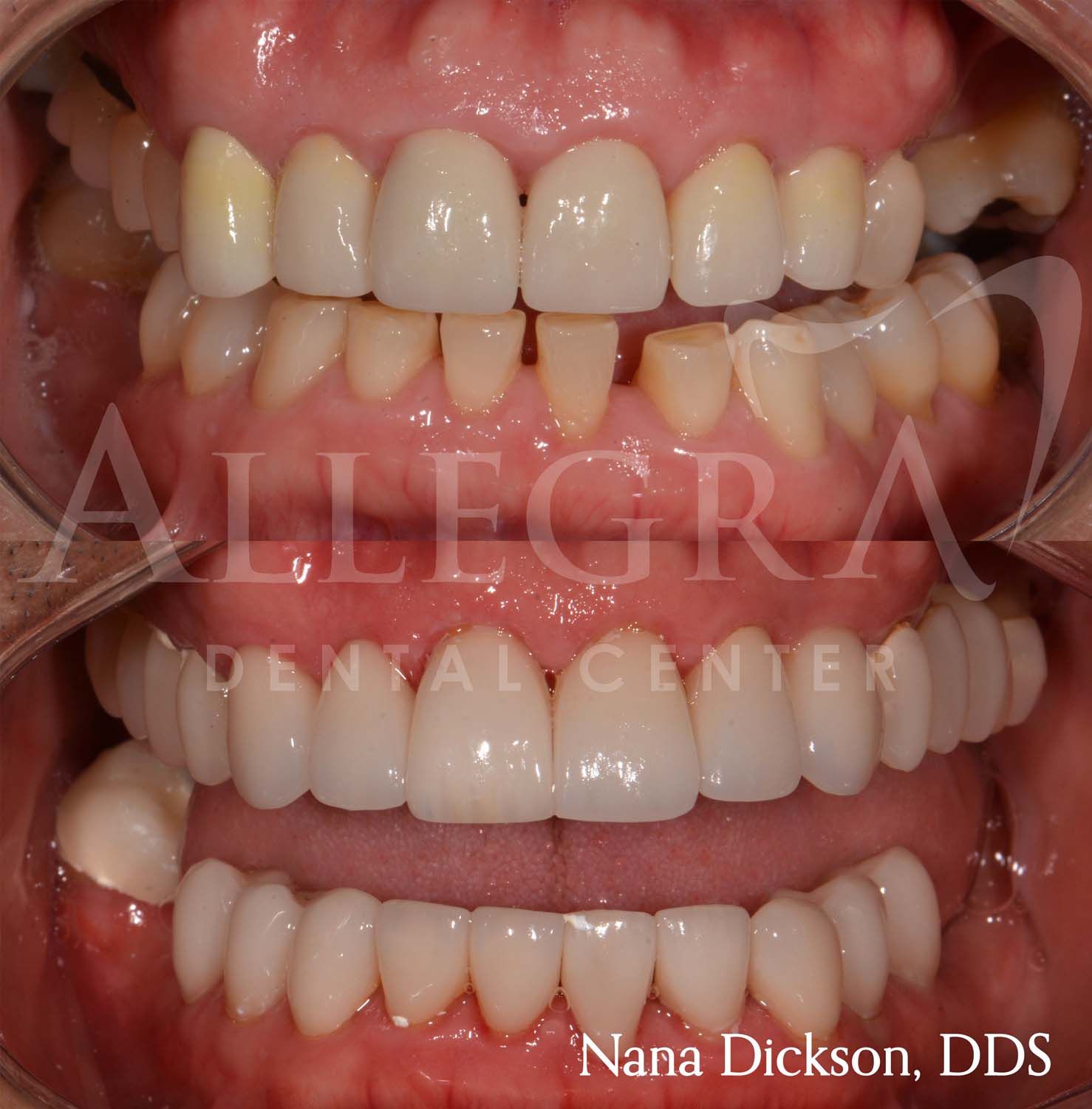 Veneers Before and After case 9 from Allegra Dental Center