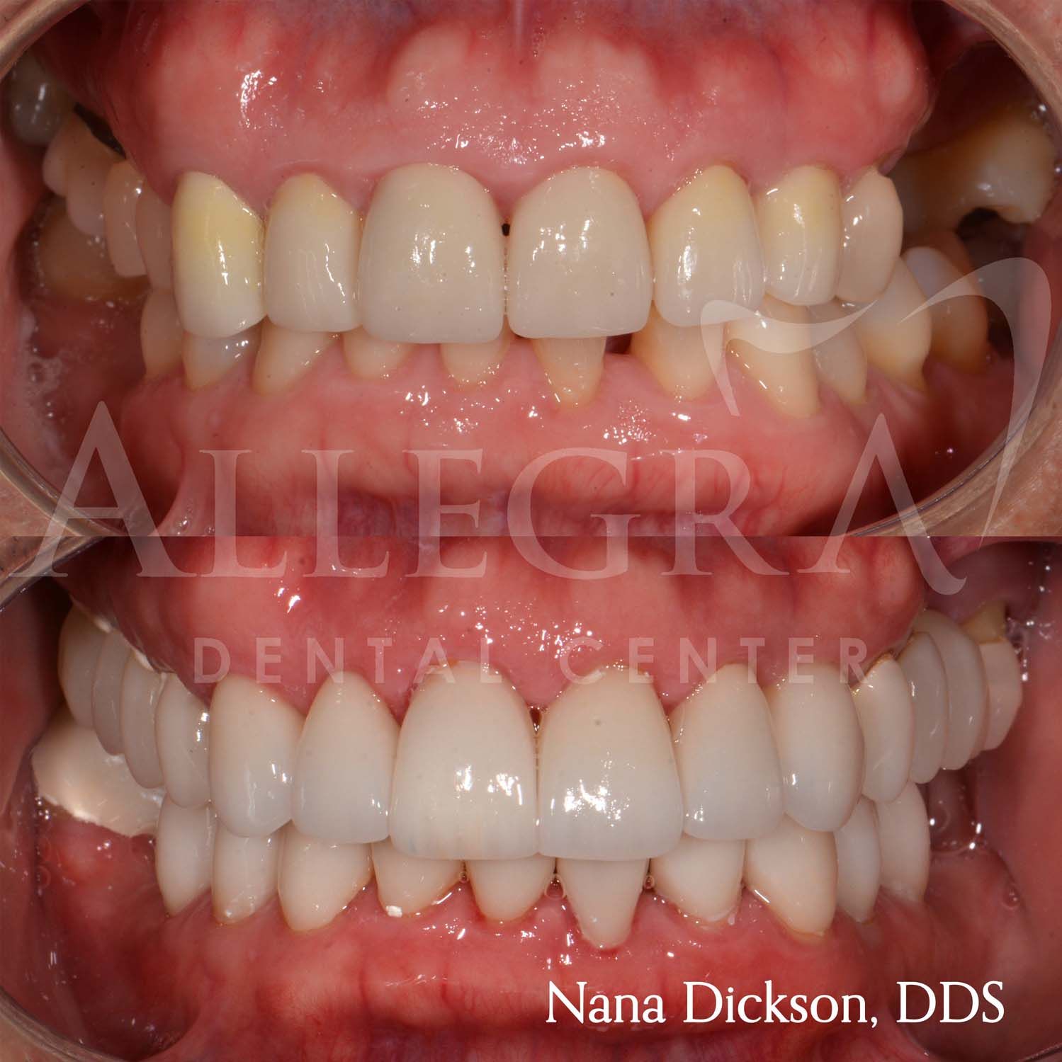 Veneers Before and After case 10 from Allegra Dental Center