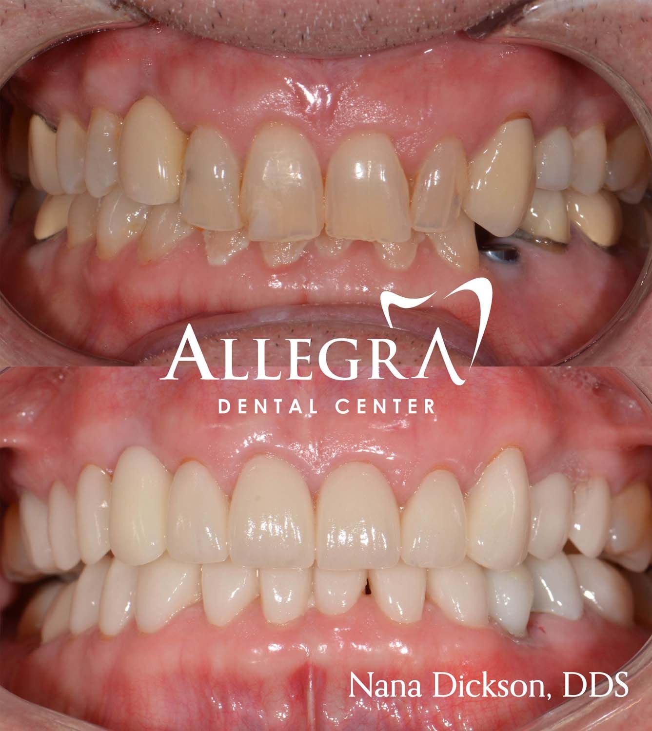Veneers Before and After case 11 from Allegra Dental Center