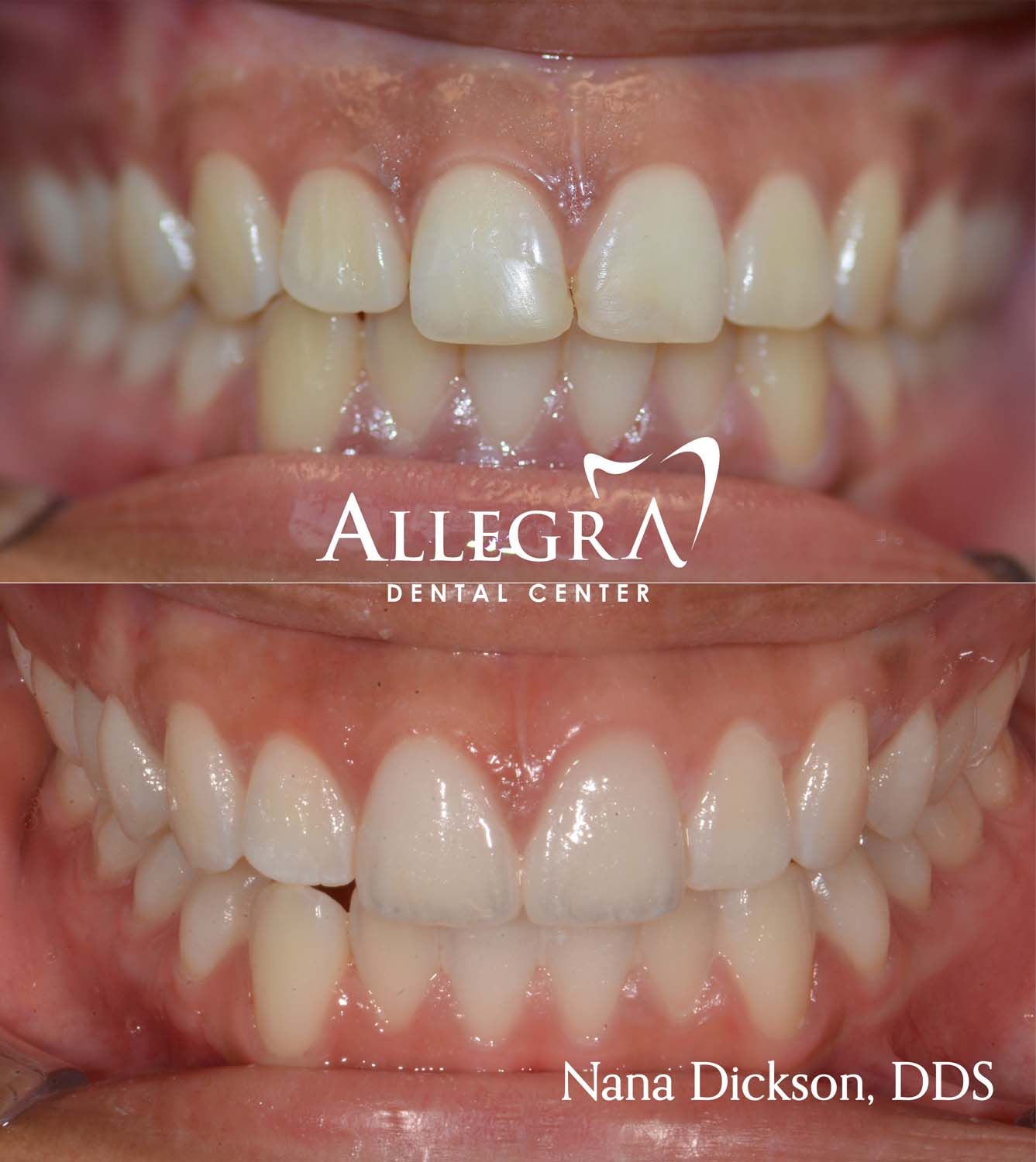 Veneers Before and After case 12 from Allegra Dental Center