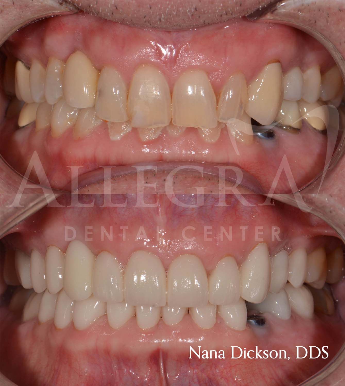 Veneers Before and After case 13 from Allegra Dental Center