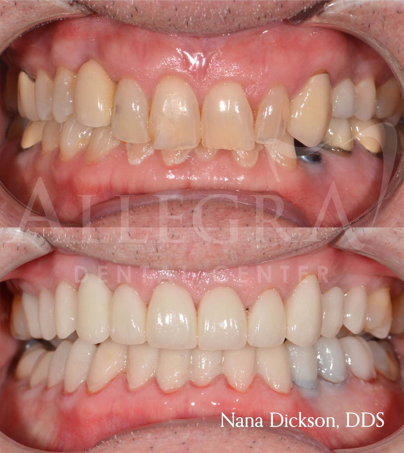 Veneers Before and After case 14 from Allegra Dental Center