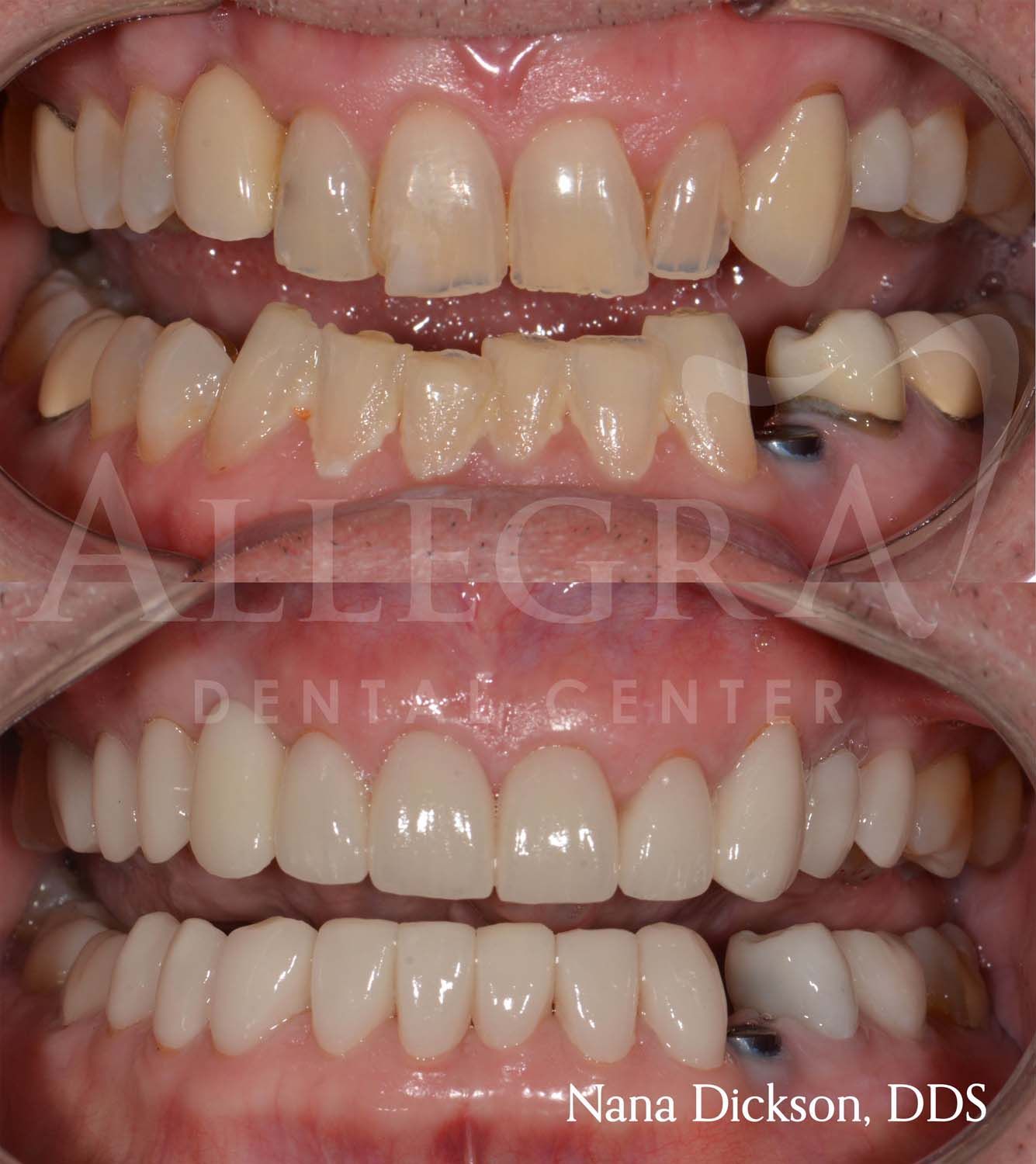 Veneers Before and After case 15 from Allegra Dental Center