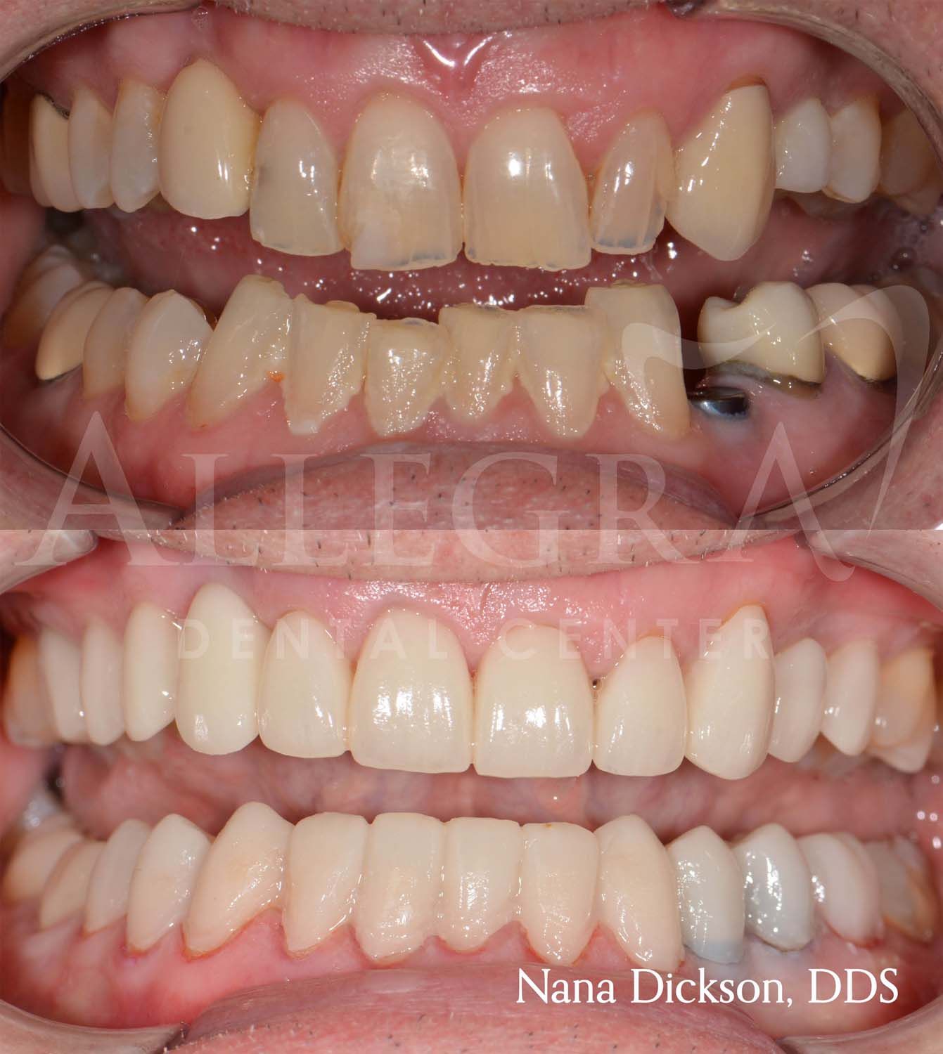 Veneers Before and After case 16 from Allegra Dental Center