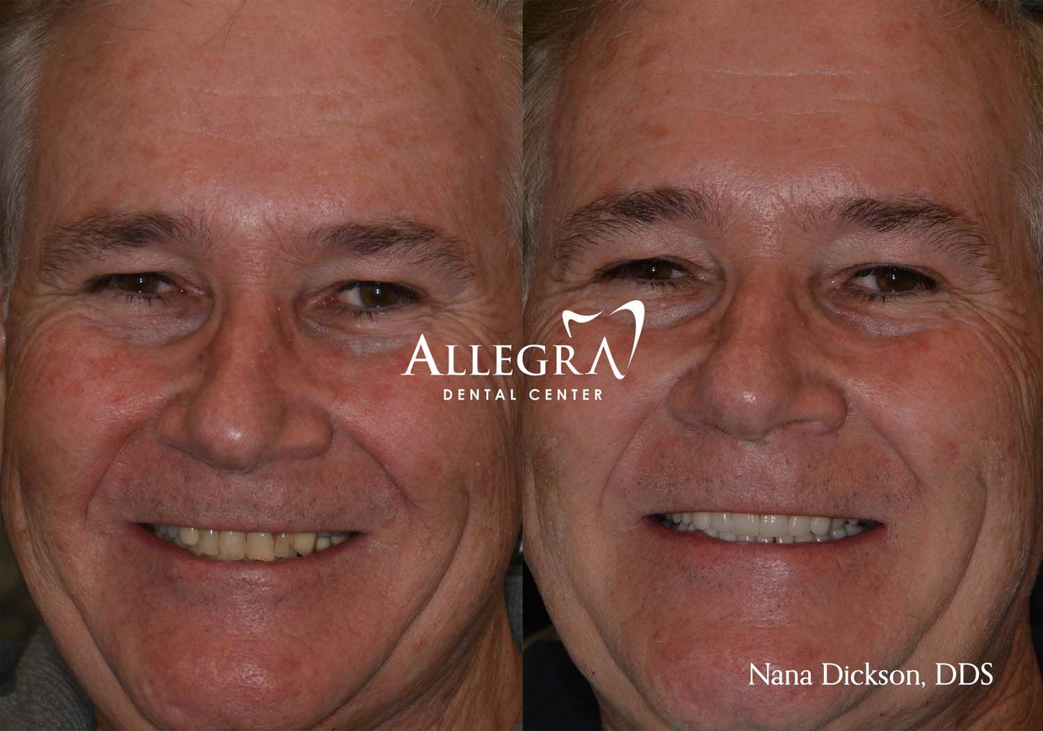 Veneers Before and After case 17 from Allegra Dental Center