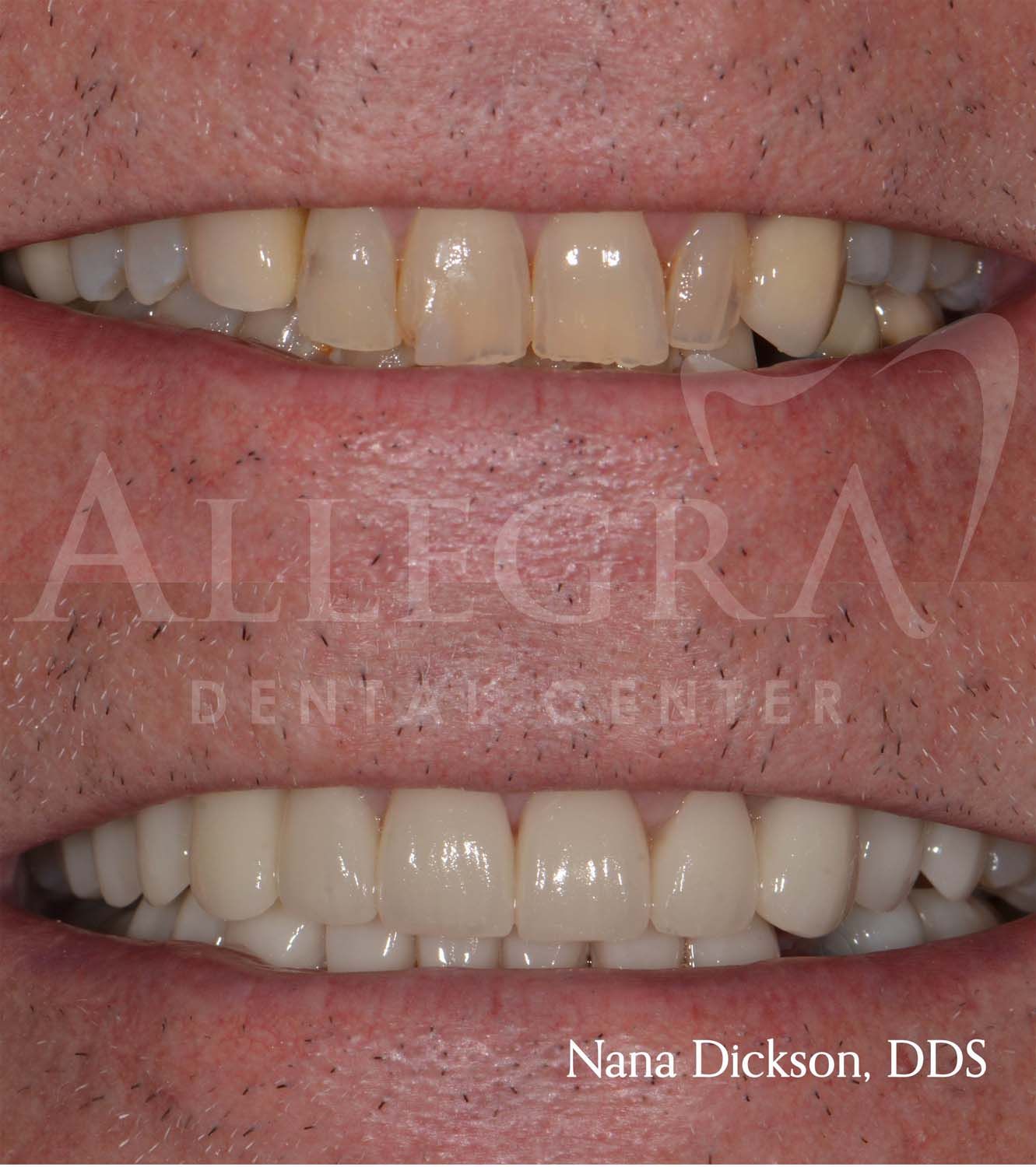 Veneers Before and After case 18 from Allegra Dental Center