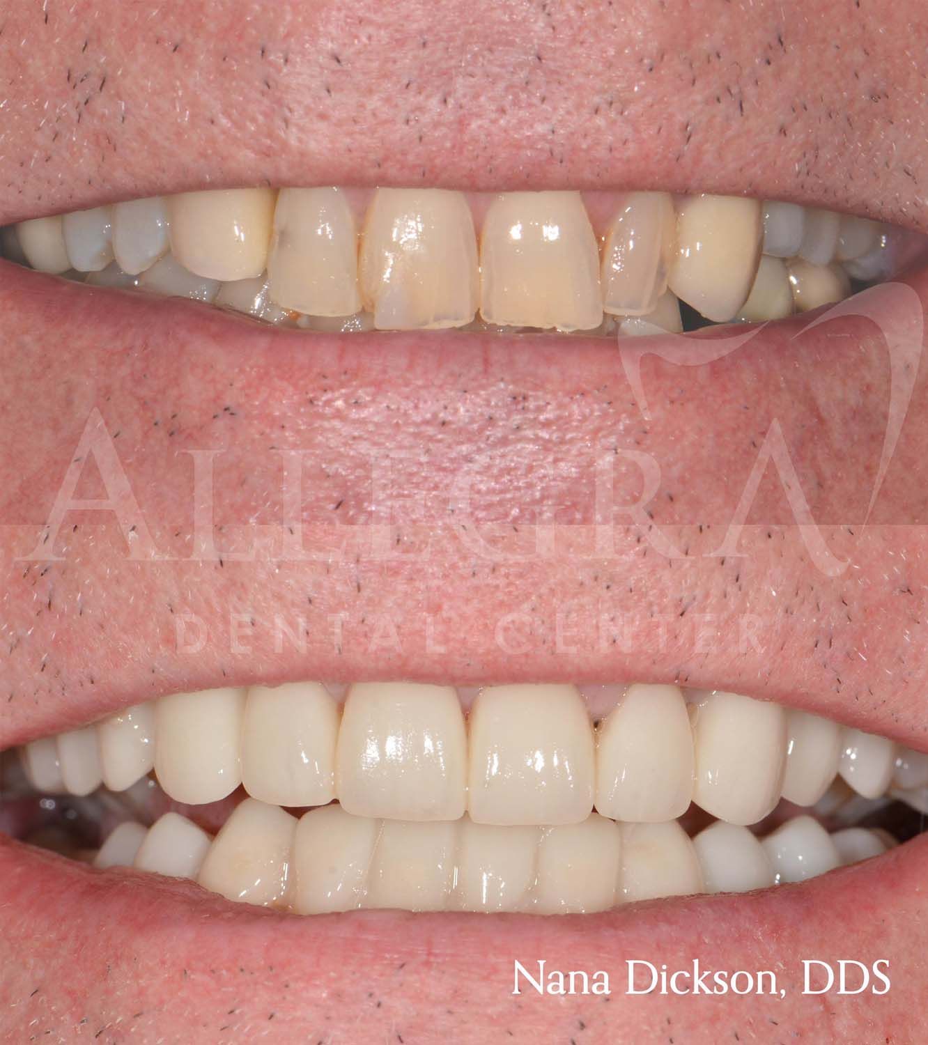 Veneers Before and After case 20 from Allegra Dental Center