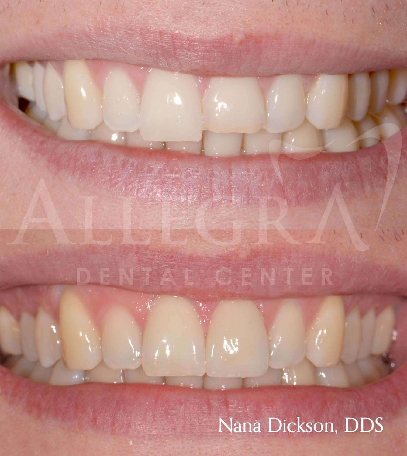 Veneers Before and After case 21 from Allegra Dental Center