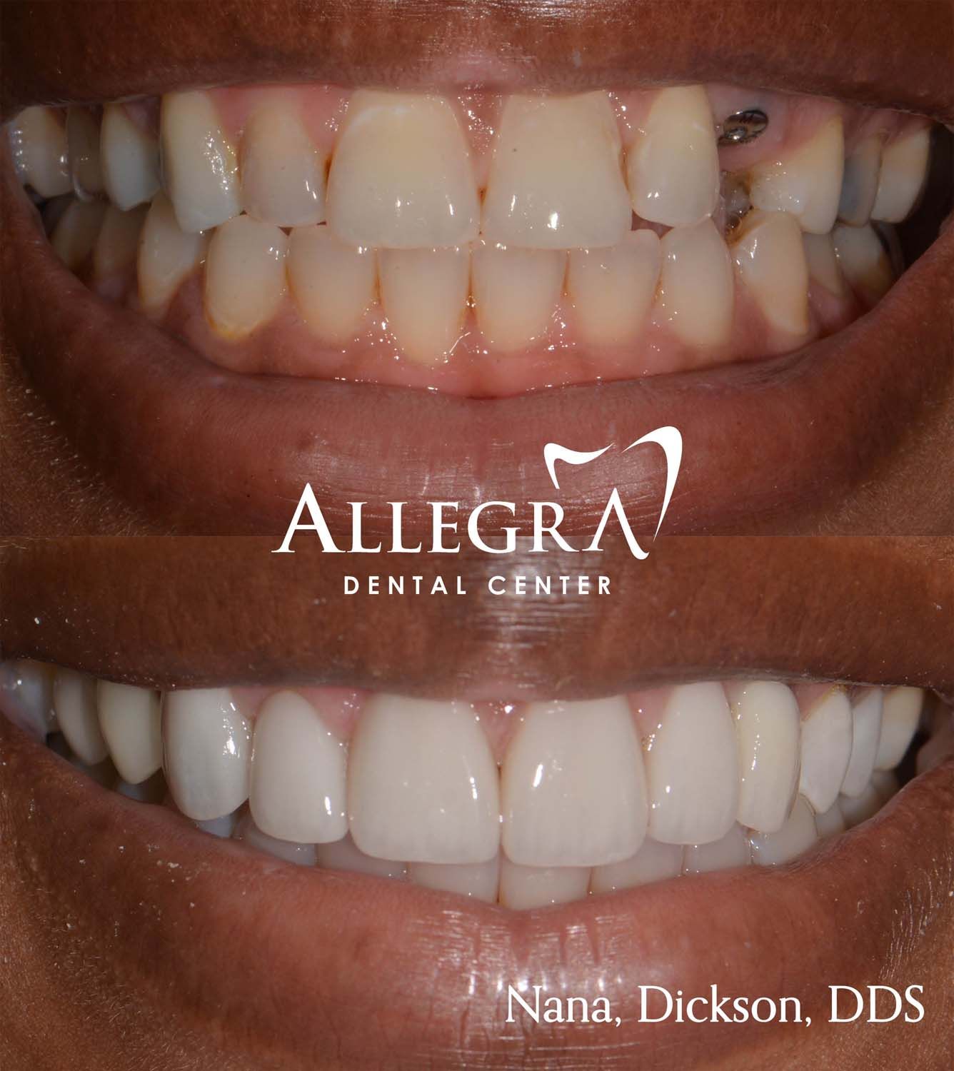 Veneers Before and After case 23 from Allegra Dental Center
