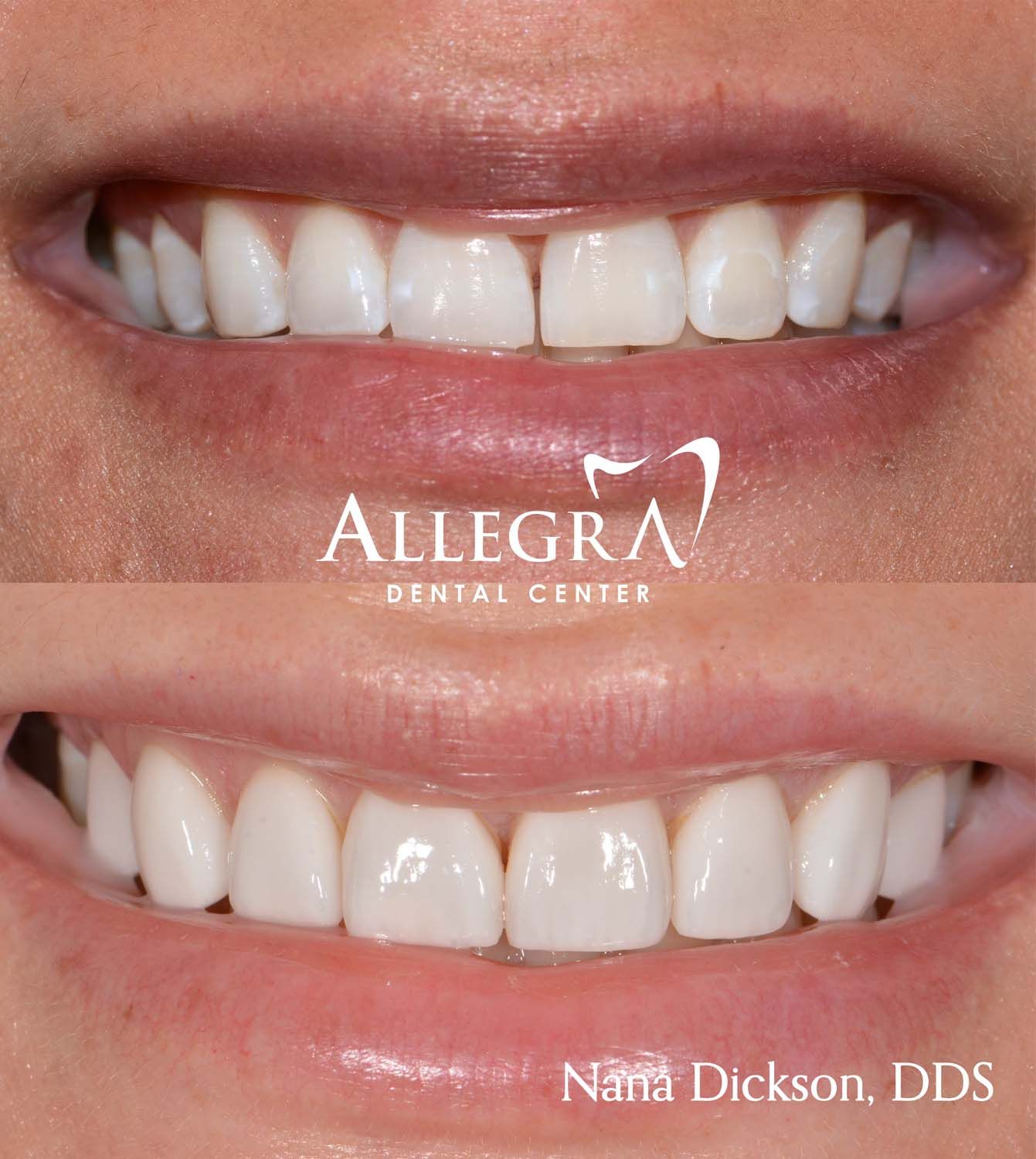 Veneers Before and After case 24 from Allegra Dental Center