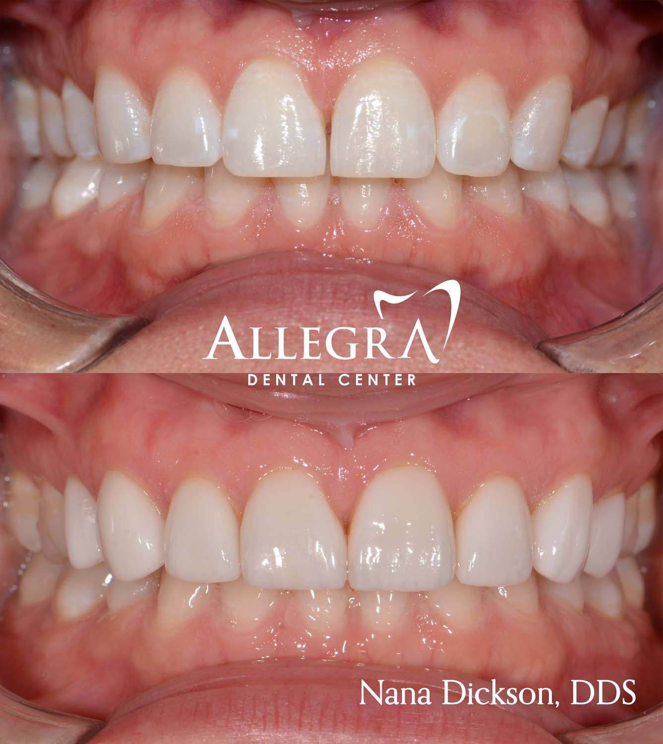 Veneers Before and After case 25 from Allegra Dental Center