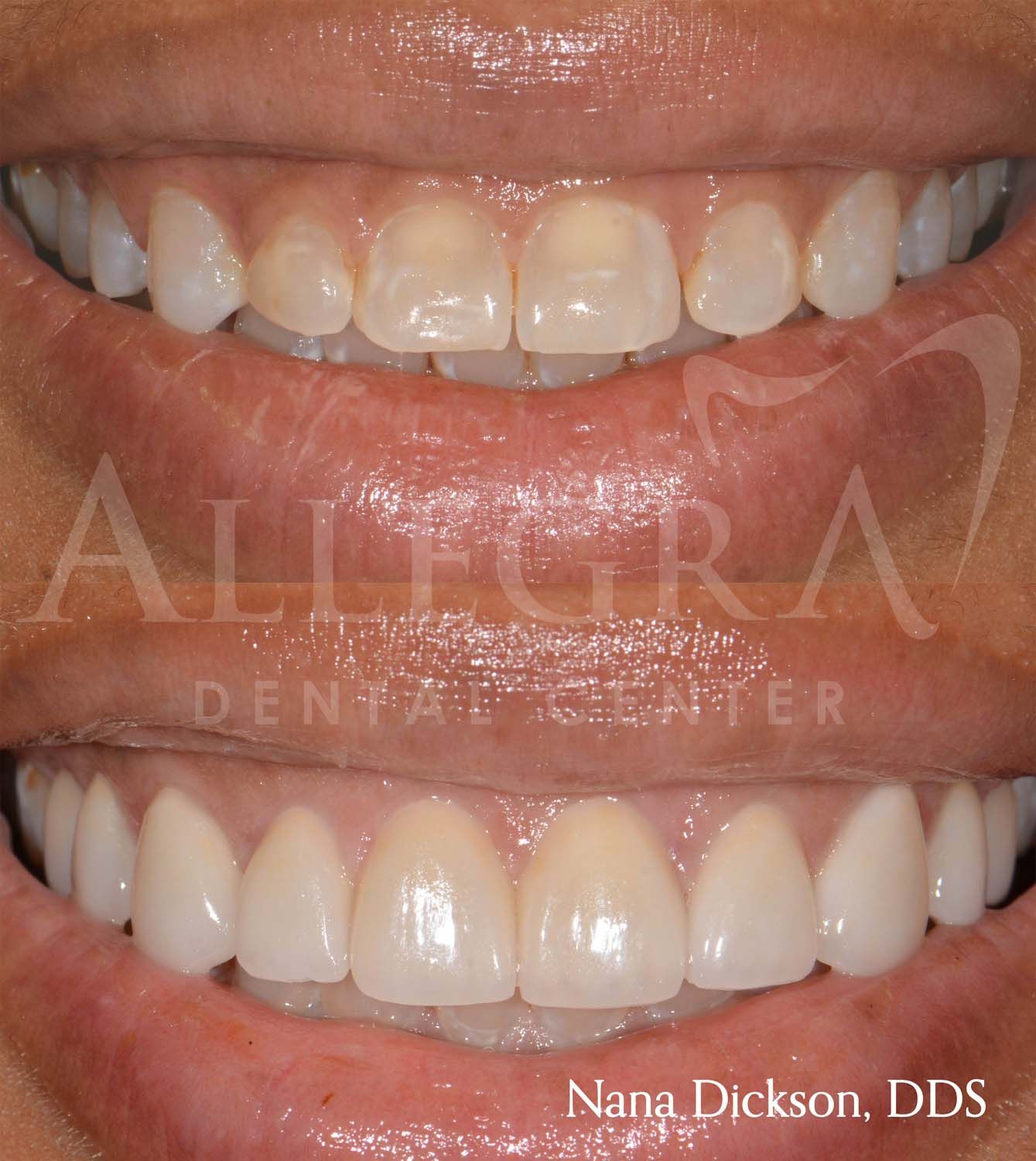Veneers Before and After case 26 from Allegra Dental Center