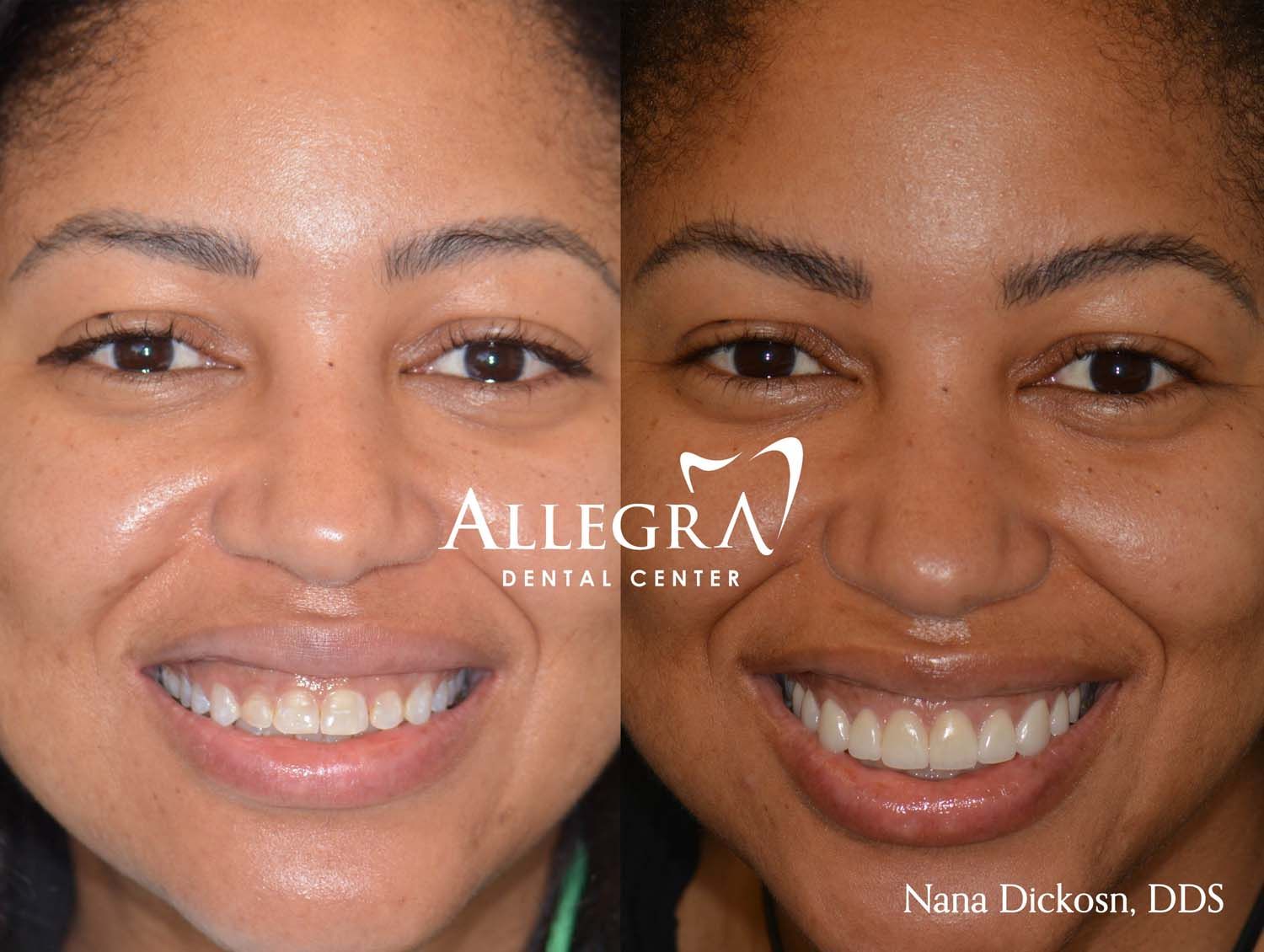 Veneers Before and After case 27 from Allegra Dental Center