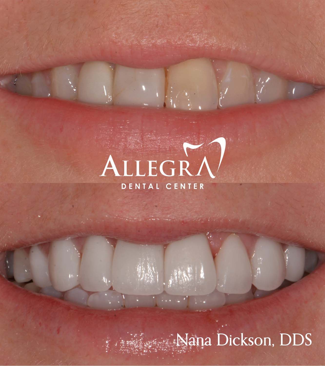 Veneers Before and After case 29 from Allegra Dental Center