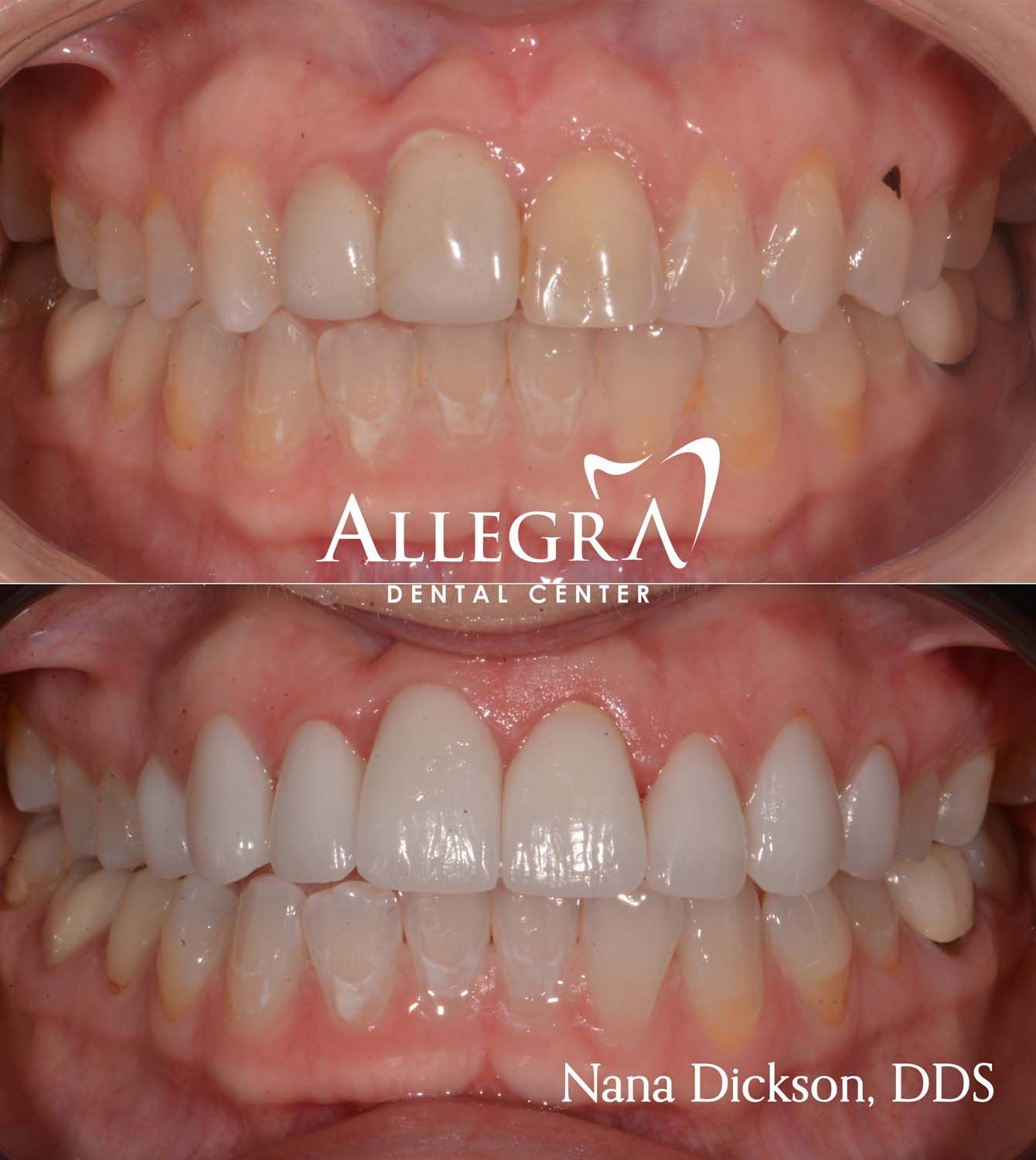 Veneers Before and After case 30 from Allegra Dental Center