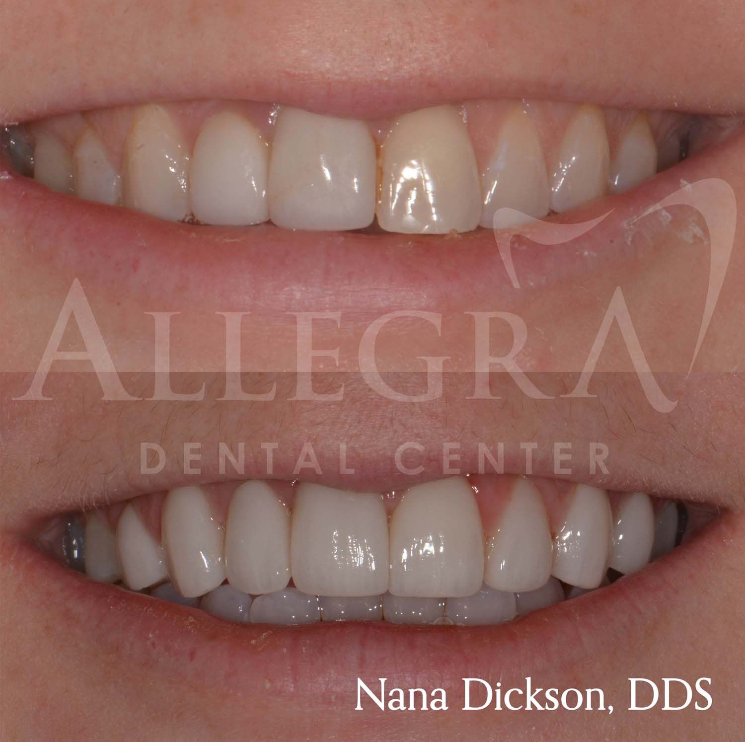 Veneers Before and After case 31 from Allegra Dental Center